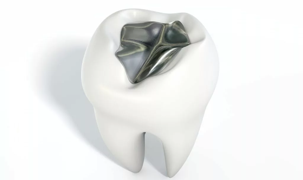 dental fillings