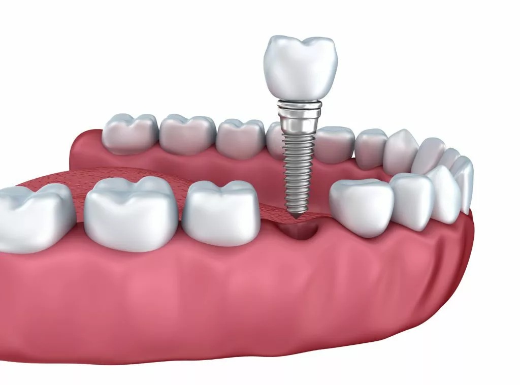 dental implants