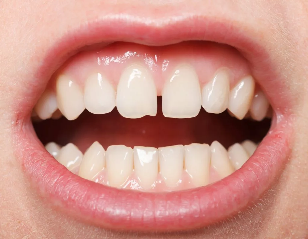 Midline-Diastema